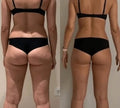 LUMA Pro - Ultrasoniq Body Toner & Cellulite Remover