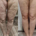 LUMA Pro - Ultrasoniq Body Toner & Cellulite Remover
